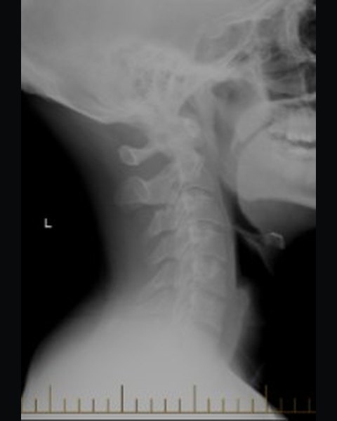 Cervical spine after 49 visits