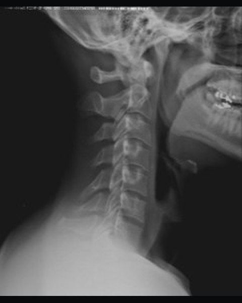 Cervical spine before treatment