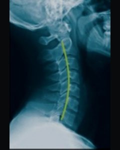 A normal cervical spine