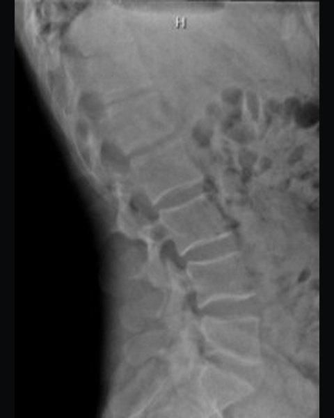 Lumbar spine after 98 visits
