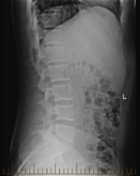 Lumbar spine before treatment