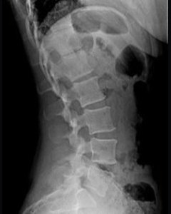 A normal lumbar spine