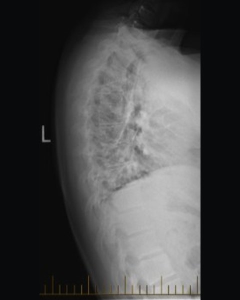 Thoracic spine after 98 visits