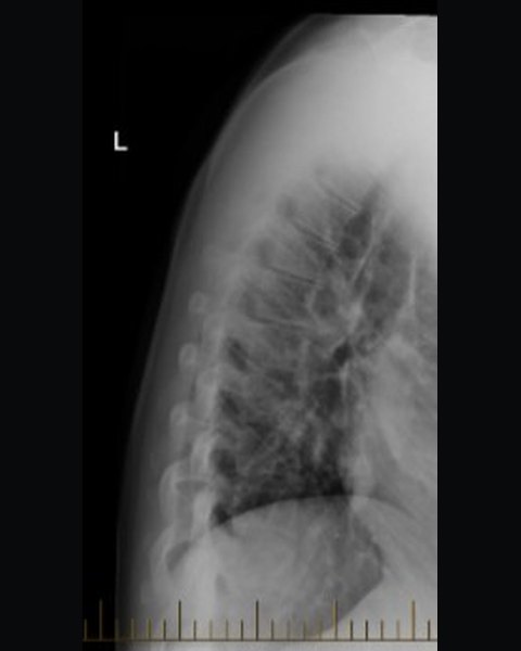 Thoracic spine before treatment