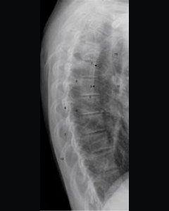 A normal thoracic spine